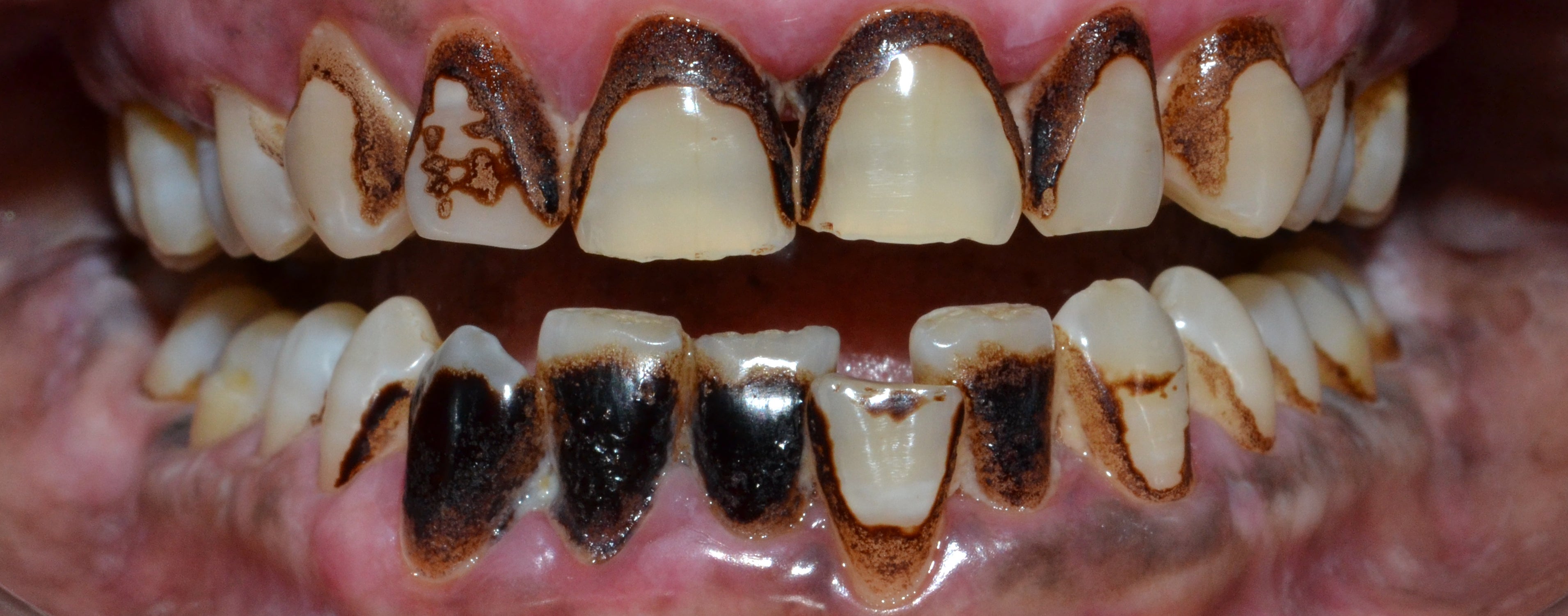 Tobacco Stain Cleaning – Regaining a Confident Smile ~ Dr. Bharat Katarmal  Dental & Implant Clinic