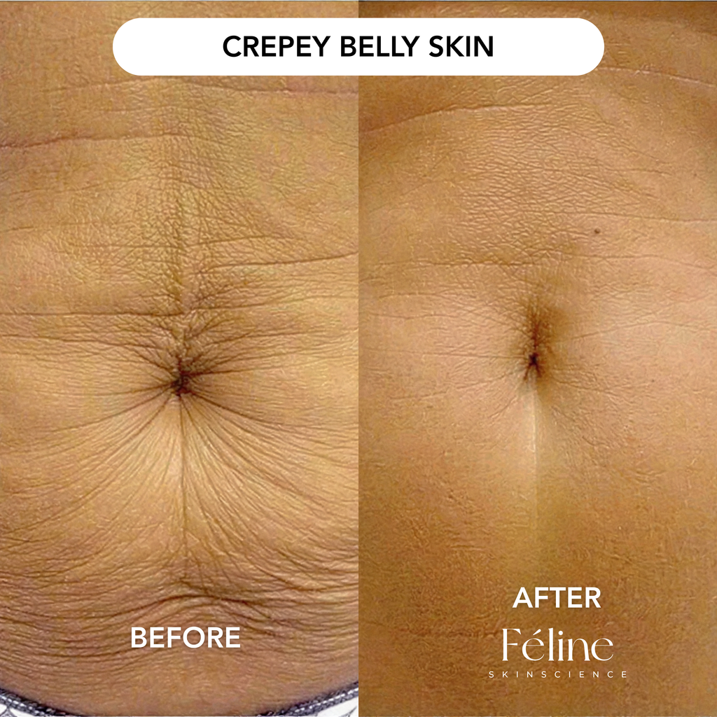 Advanced Arm Crepe Fix | 1+1 FREE