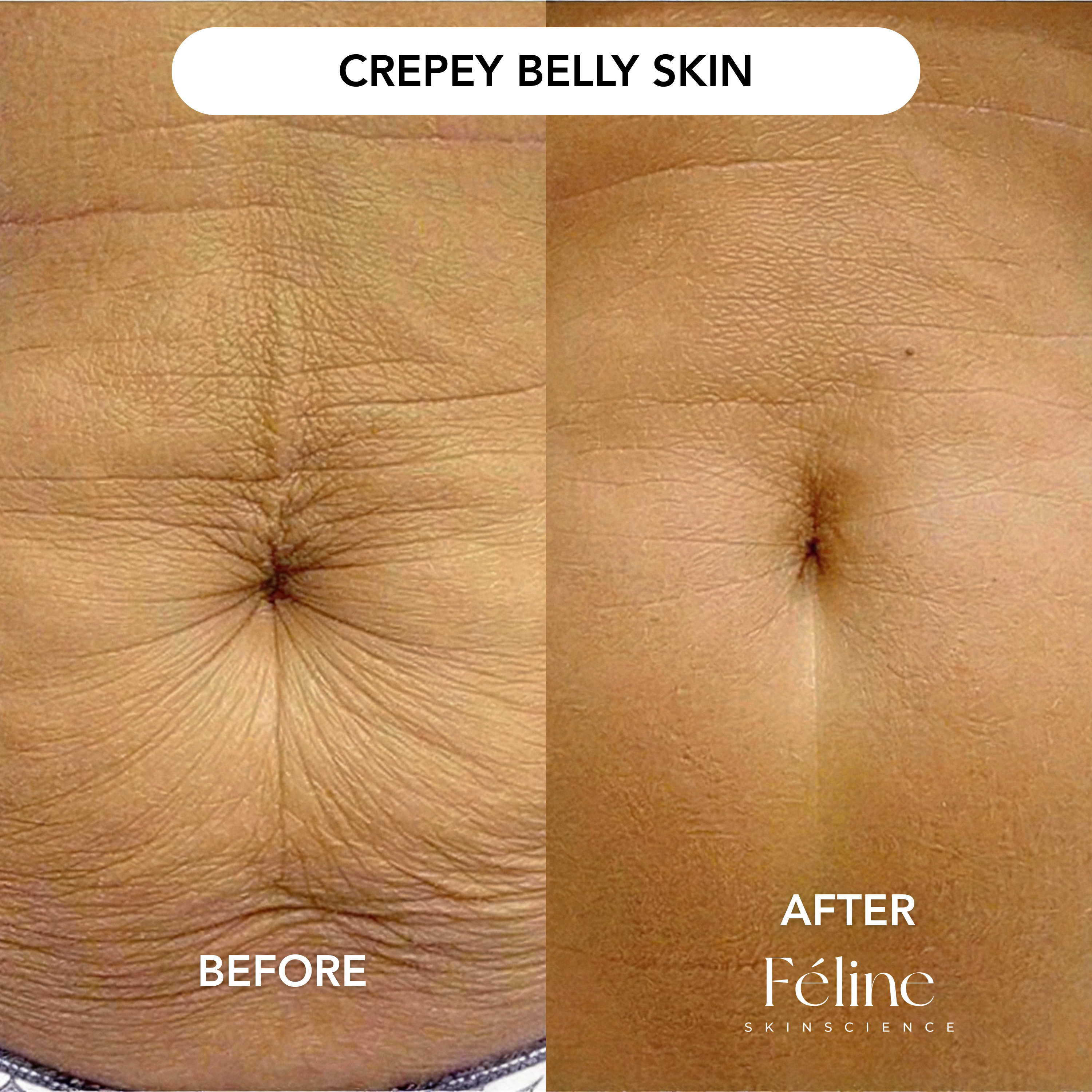 Advanced Arm Crepe Fix | 1+1 FREE