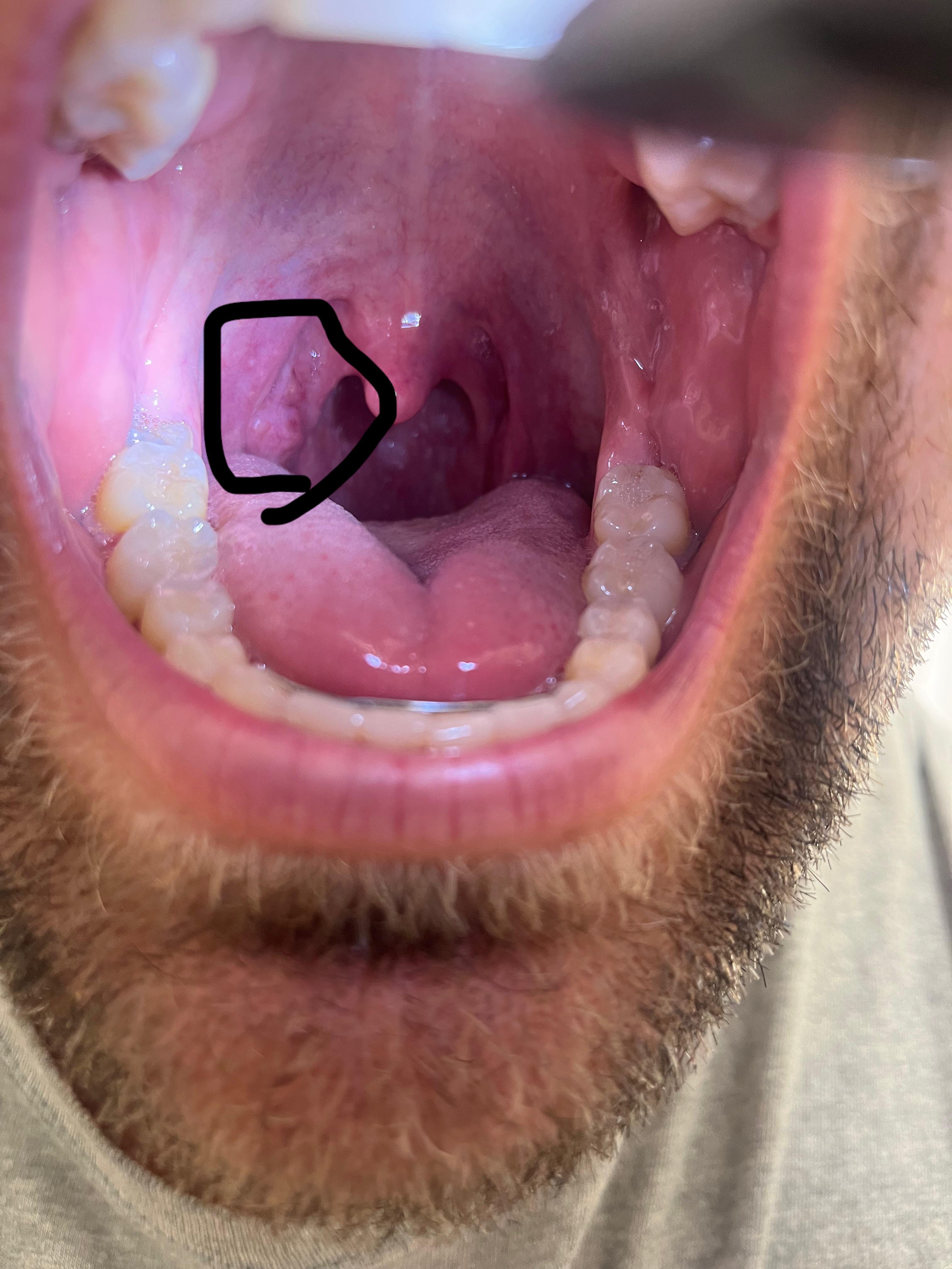 can chewing tobacco cause tonsillitis I'm worried about this tonsil. I've chewed  tobacco on