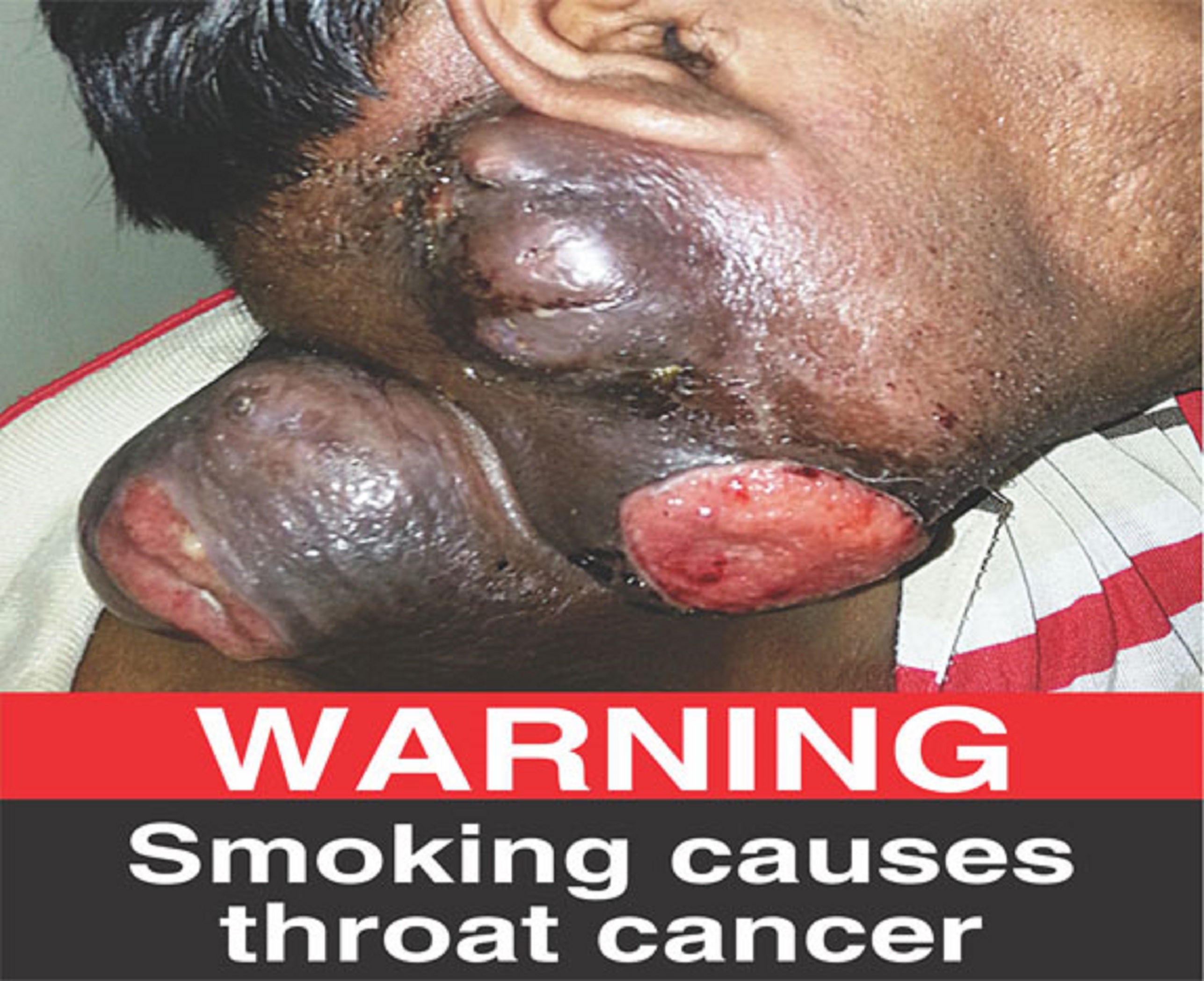 Warning - Smoking causes throat cancer